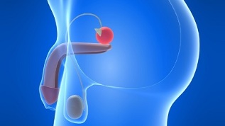 prostate massage for the prevention of prostatitis