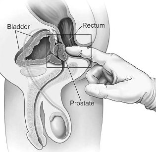 treatment of inflammation of the prostate in home massage
